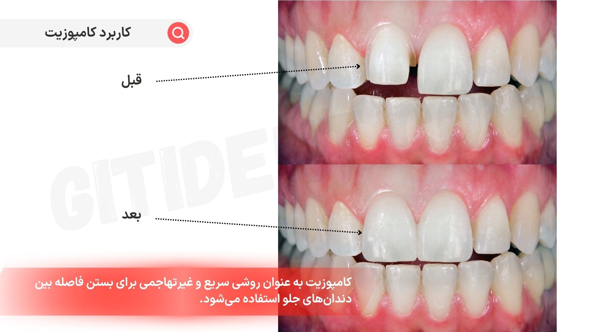 بستن فاصله بین دندان‌ها با کامپوزیت دندان