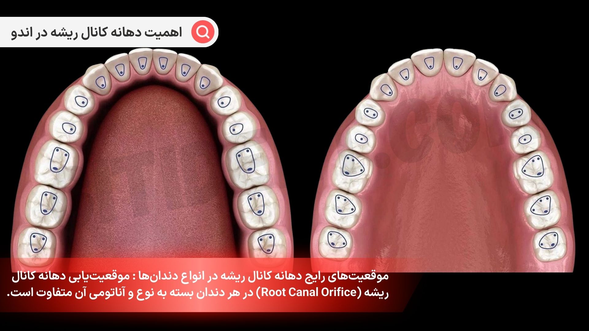 موقعیت‌های رایج دهانه کانال ریشه در انواع دندان‌ها