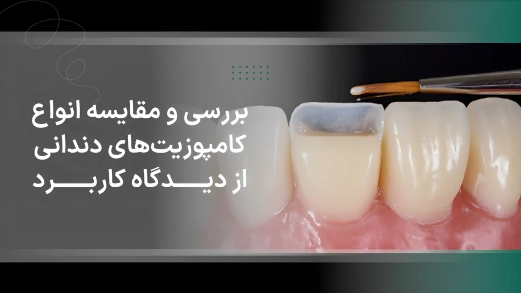 بررسی و مقایسه انواع کامپوزیت‌های دندانی از دیدگاه کاربرد