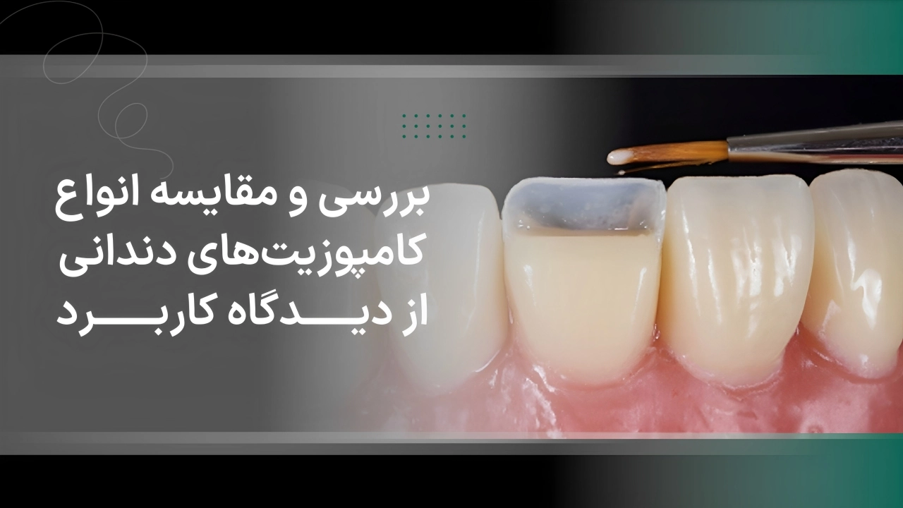بررسی و مقایسه انواع کامپوزیتهای دندانی از دیدگاه کاربرد
