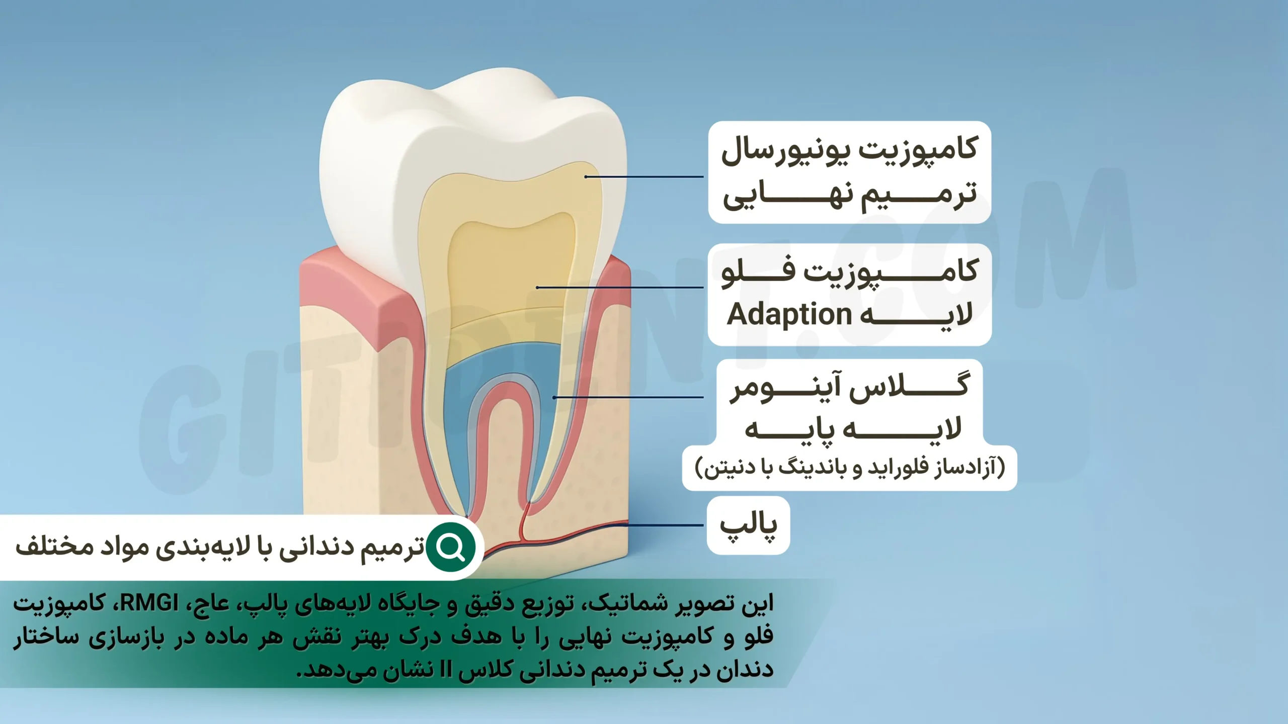 بررسی مقایسه‌ای گلاس آینومر و کامپوزیت فلو در نقش لایه زیرین ترمیم‌های مستقیم- نمای سه‌بعدی مقطعی از ترمیم دندانی با لایه‌بندی مواد مختلف